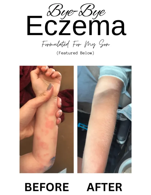 Bye-Bye Eczema Lotion